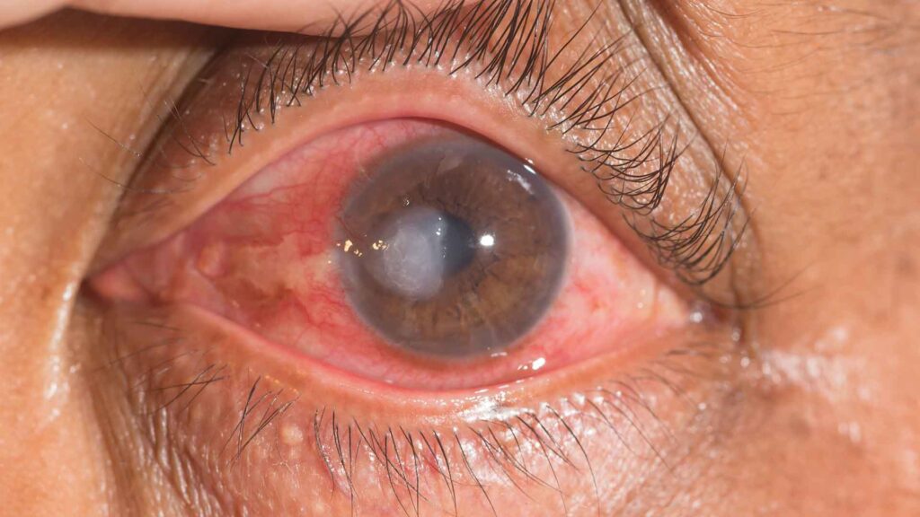 Severe Corneal Ulcer