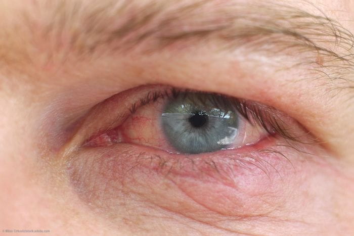 What causes dry eye after cataract surgery?