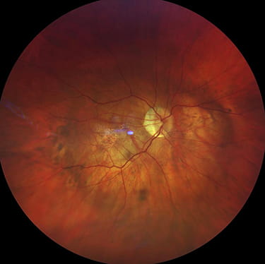 Staphyloma Appearance