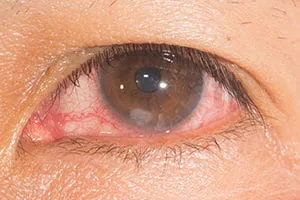 Corneal Ulcer Healing Stages