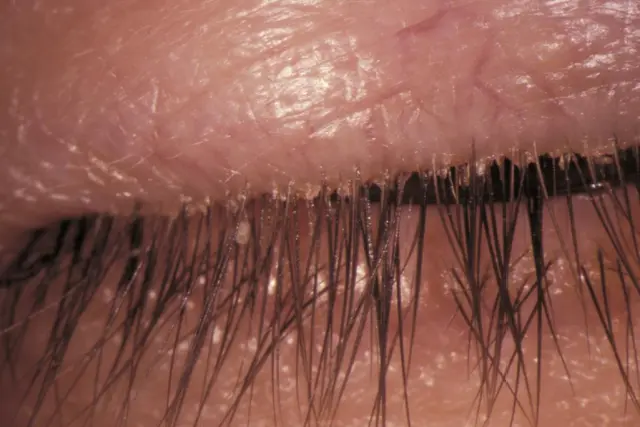 Blepharitis